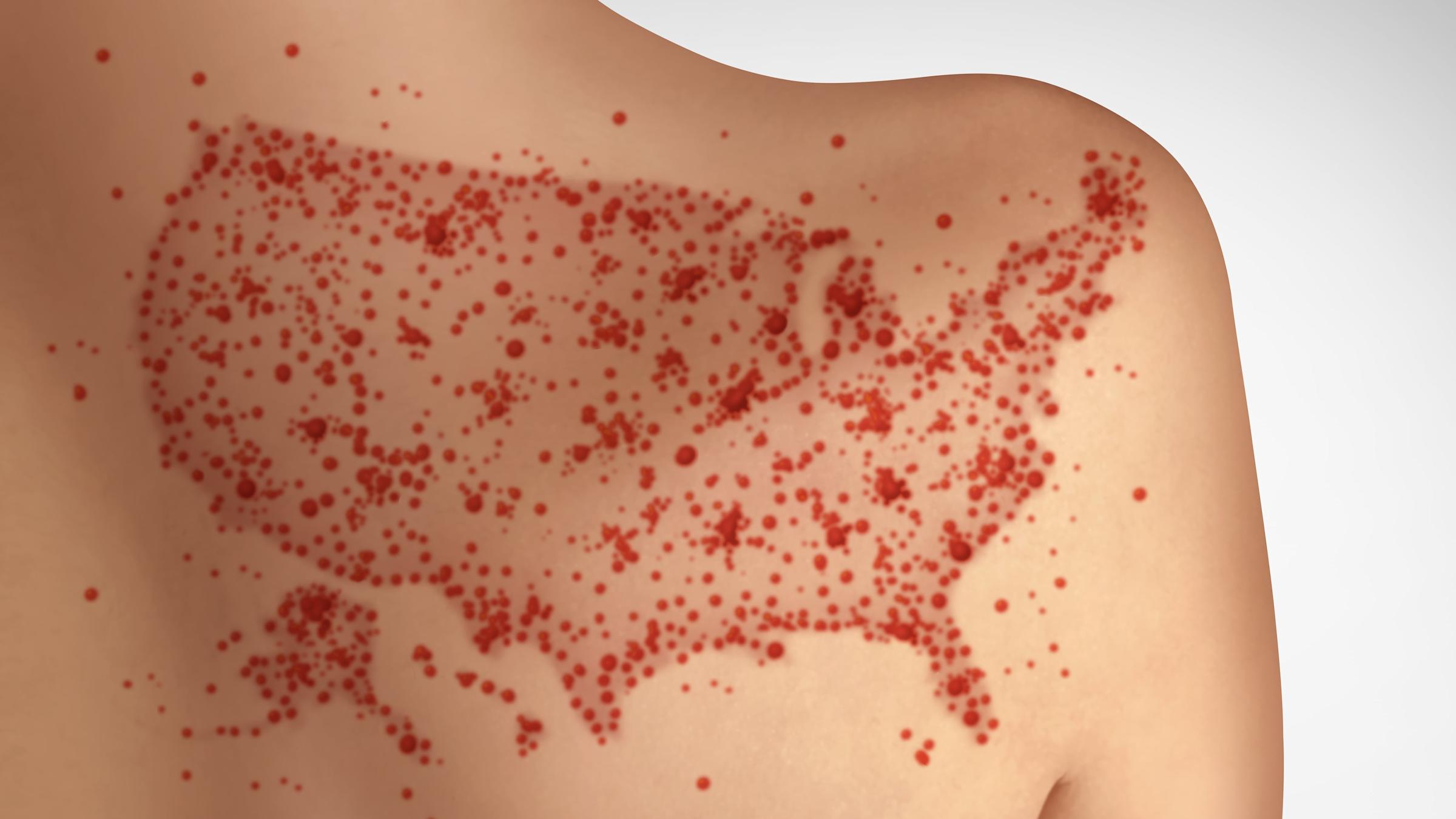 measles across US