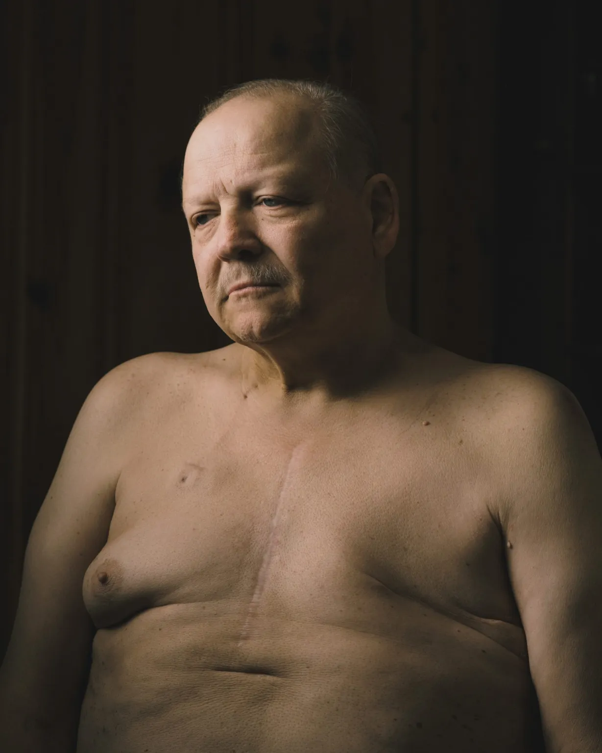 Navy veteran Kirby Lewis has Stage 4 breast cancer and had a left breast mastectomy after being diagnosed about a dozen years ago. A new VA policy would make it harder for male veterans to get health care coverage for newly diagnosed breast cancer. Greg Kahn for ProPublica Navy veteran Kirby Lewis has Stage 4 breast cancer and had a left breast mastectomy after being diagnosed about a dozen years ago. A new VA policy would make it harder for male veterans to get health care coverage for newly diagnosed breast cancer. Greg Kahn for ProPublica