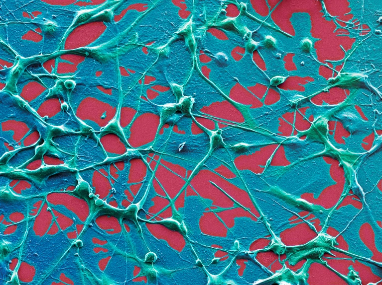 Melanoma cells (artificially coloured). An immune-based therapy was more effective against this cancer in people who received an mRNA-based COVID-19 vaccine within 100 days of the start of their cancer treatment.Credit: Steve Gschmeissner/SPL