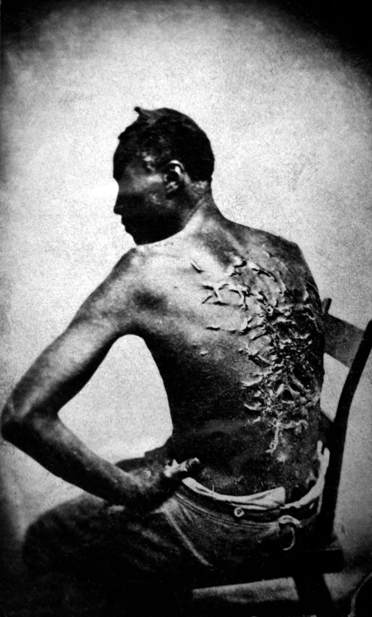 Scars of a whipped Mississippi slave, photo taken (April 2, 1863, Baton Rouge, Louisiana, USA. Original caption: Scars of a whipped Mississippi slave, photo taken (April 2, 1863, Baton Rouge, Louisiana, USA. Original caption: